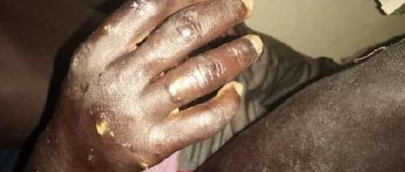 Sénégal: Une “maladie mystérieuse” apparaît à Thiaroye Sur-Mer