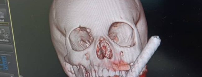Quand la solidarité et le savoir-faire chirurgical sauvent un enfant d’un traumatisme effroyable